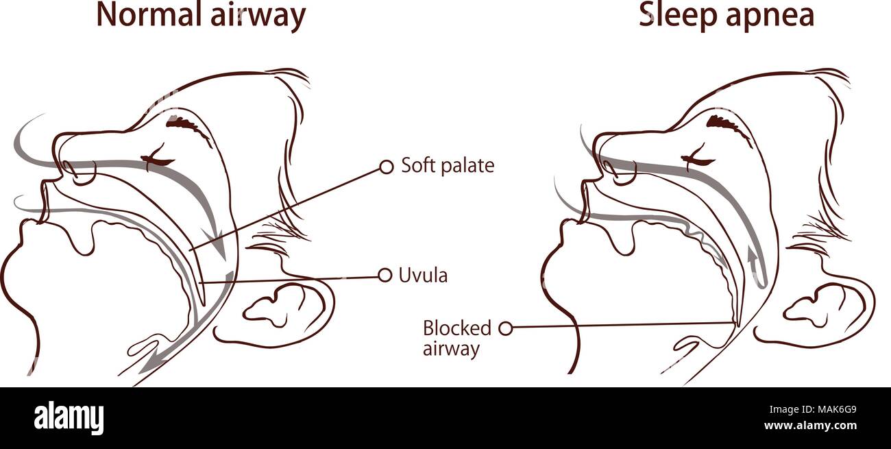 SLEEP APNEA SYNDROME Stock Vector