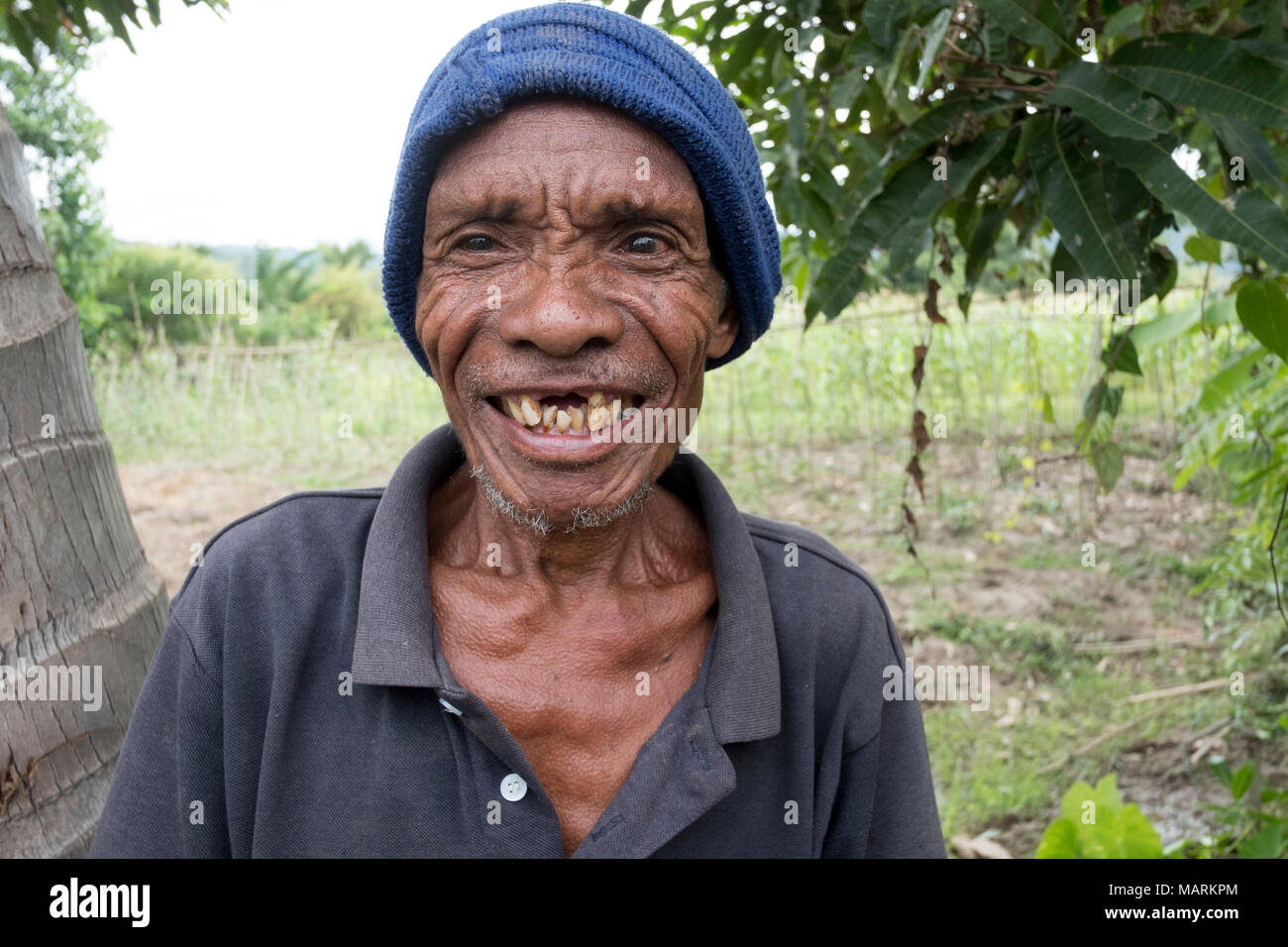 An elderly villager in Kasait, Liquica, Timor-Leste. Because of a lack of infrastructure in the mountains, access to healthcare is difficult for the villagers and there is widespread malnutrition. This man is also losing his teeth, due to the fact there are no dental facilities. Stock Photo