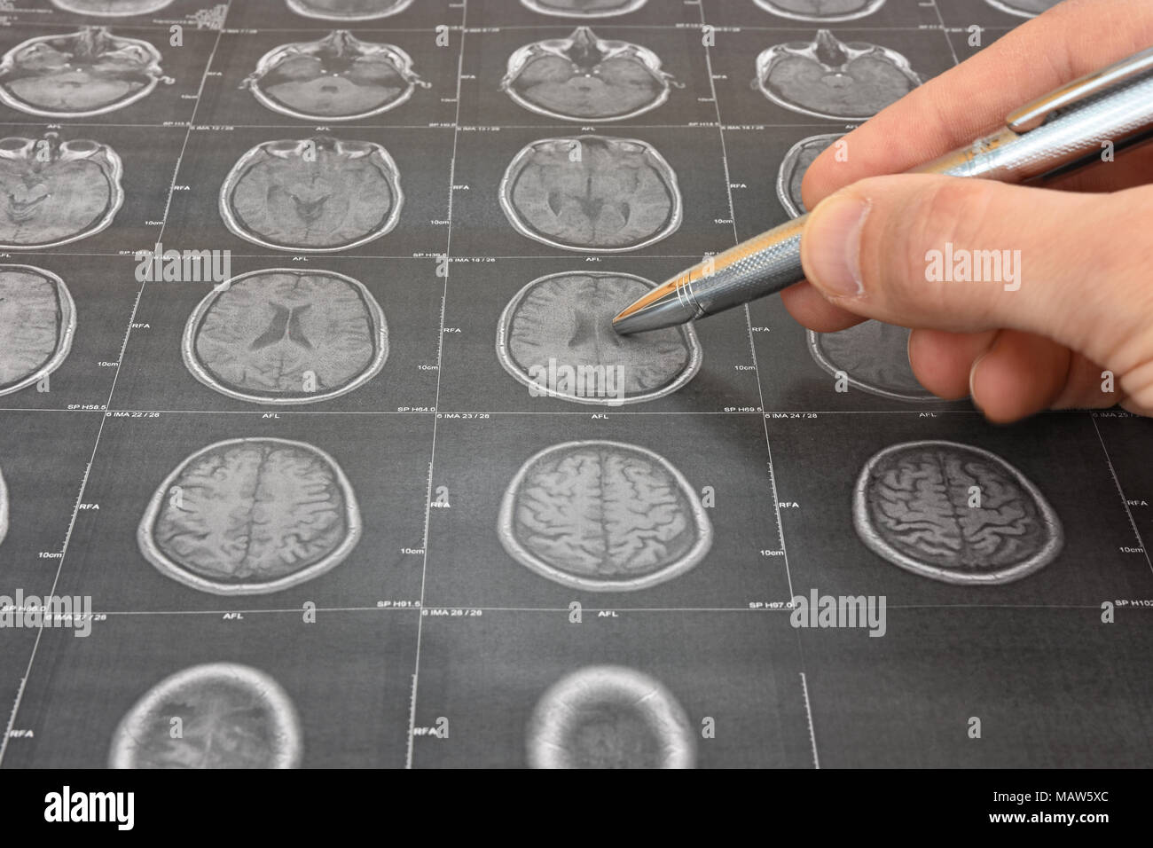 Doctor hand with a pen pointing at a MRI scan (transverse view) of the human brain Stock Photo