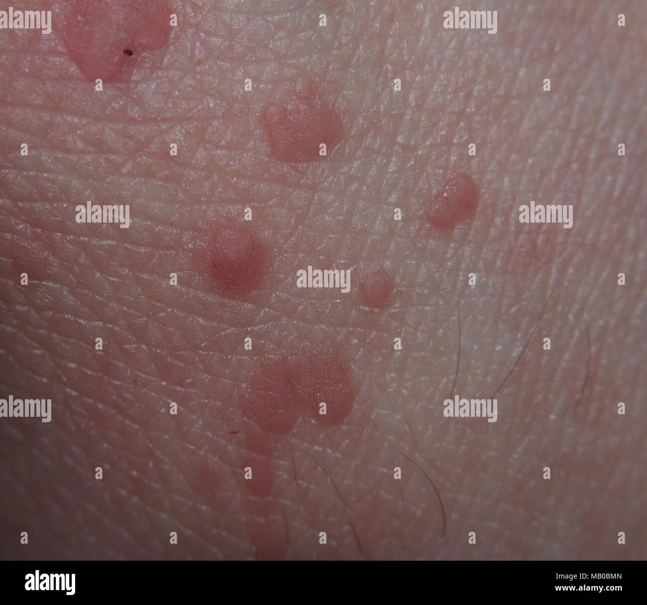 Warts on the skin of human hands. Skin disease. Macro mode. Stock Photo