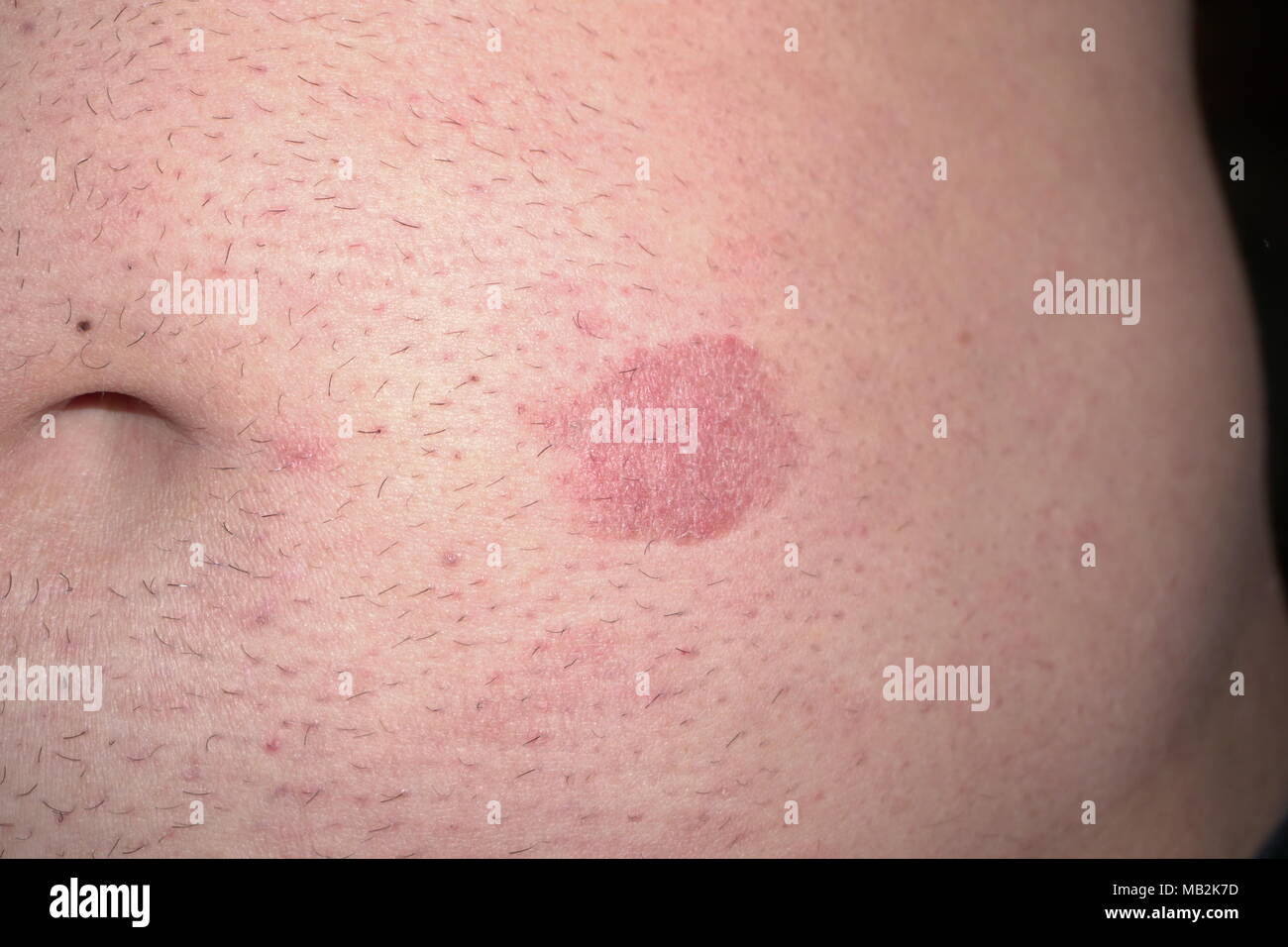 Typical skin spots from Mycosis fungoides sease Stock Photo