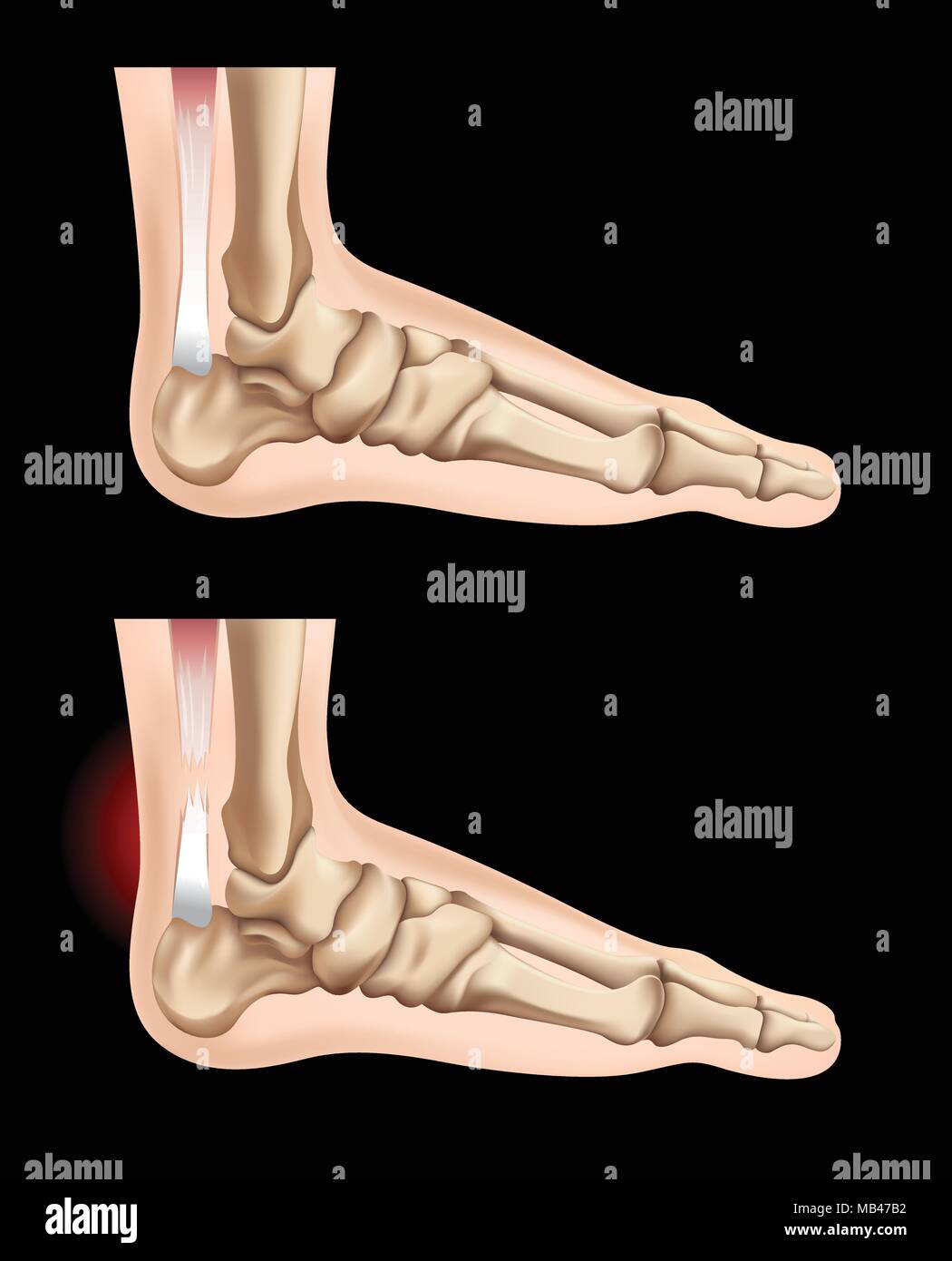 Human feet and injury in tendon illustration Stock Vector