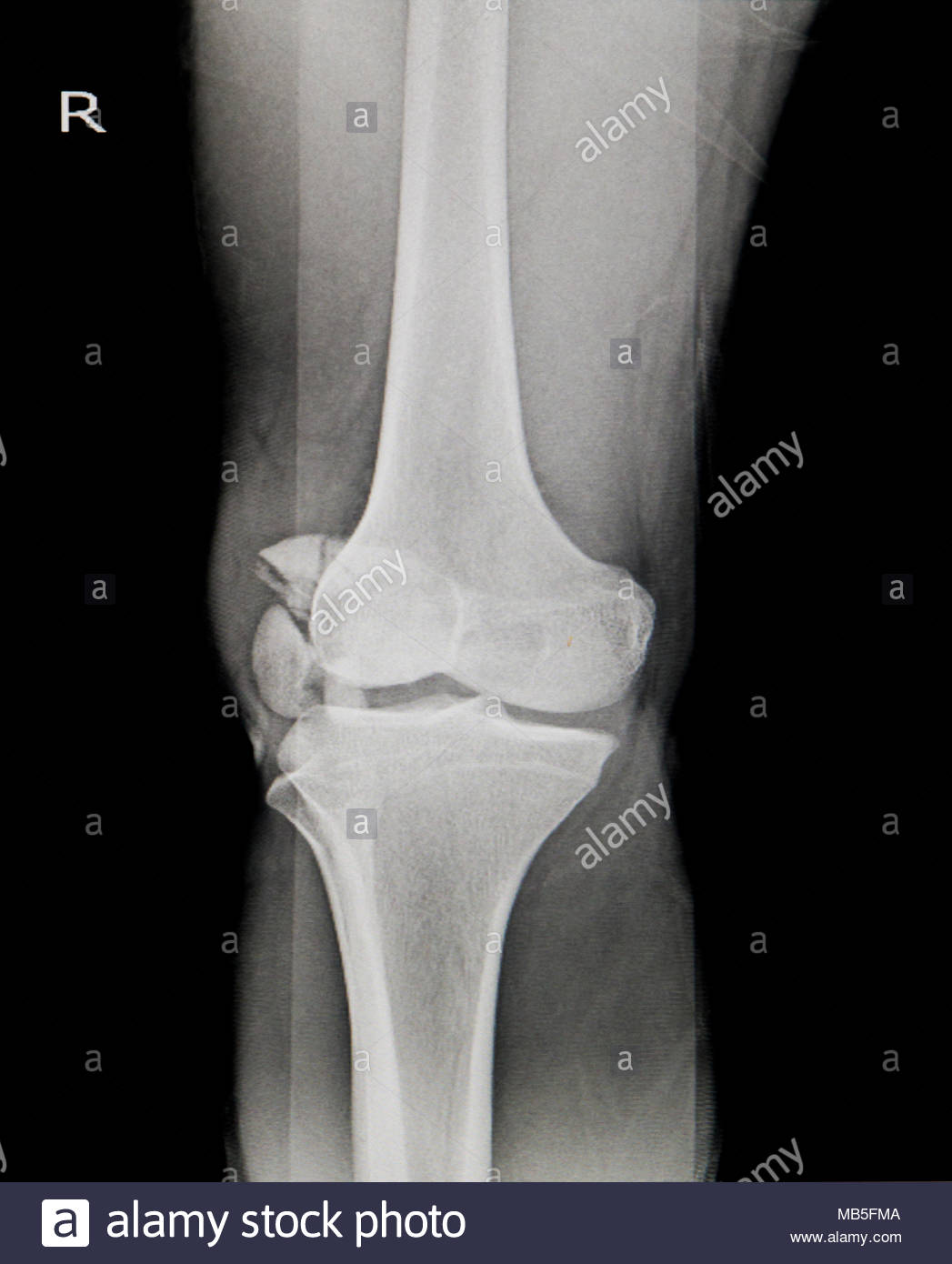 X Ray Of Knee Stock Photos & X Ray Of Knee Stock Images Alamy