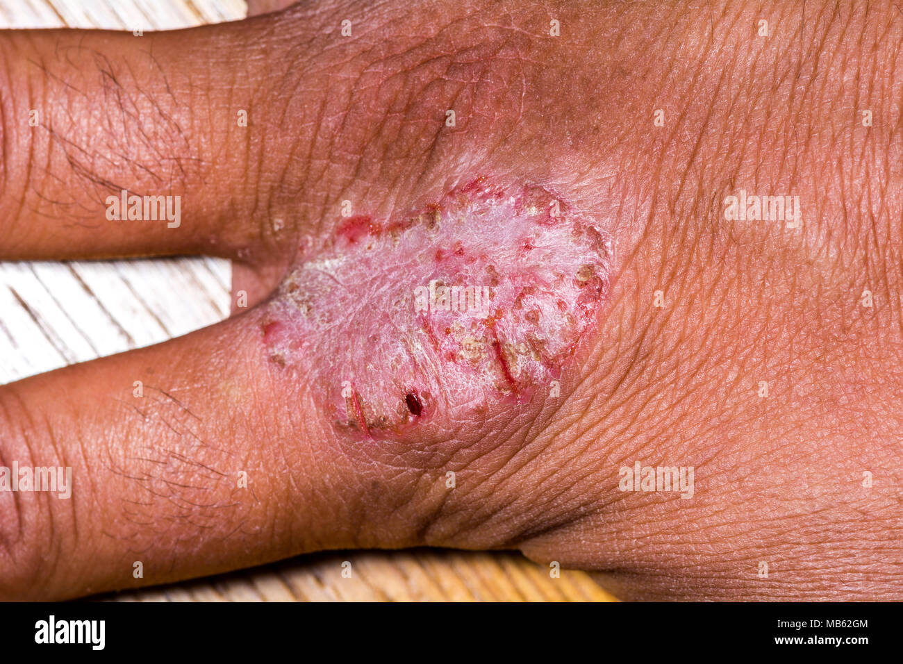 Close up of eczema or psoriasis on hand skin with open wounds, peel and crust. Stock Photo