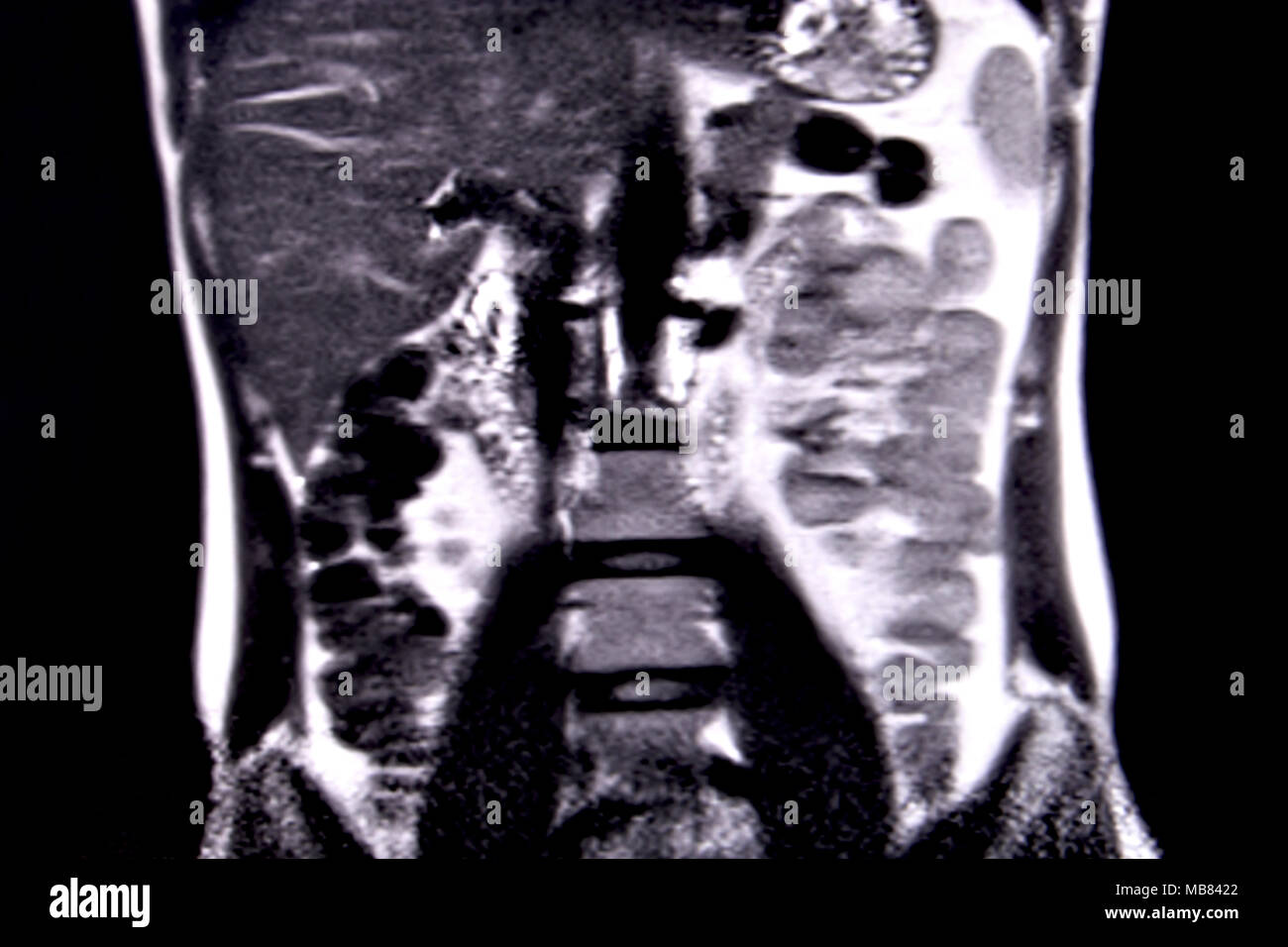 Ride through the human abdomen and chest by means of 18 MRI cuts (coronal view). Picture 5/18 Stock Photo