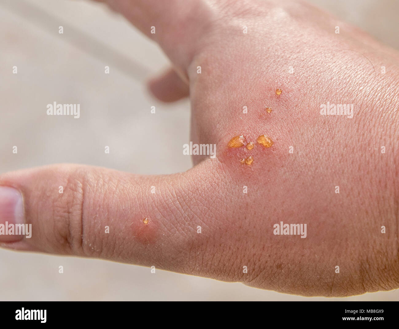 Man's hand with puss coming out of bites inflicted by some tropical insects. Stock Photo