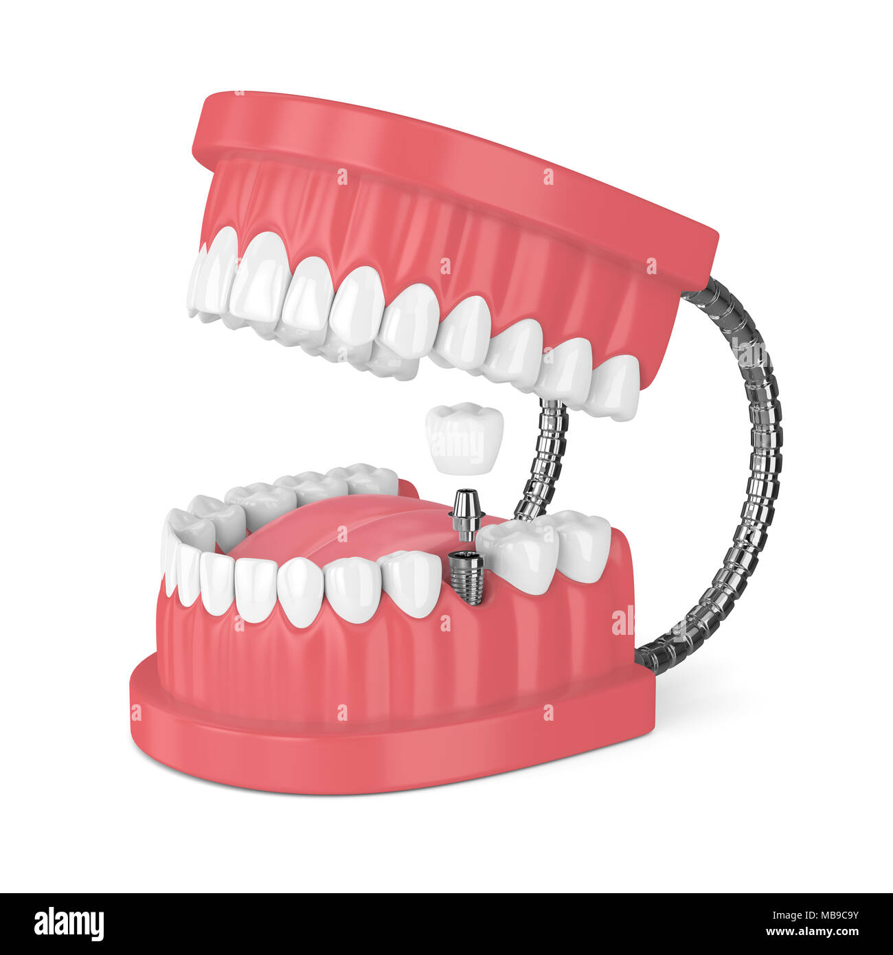 3d render of jaw with teeth and dental molar implant over white ...