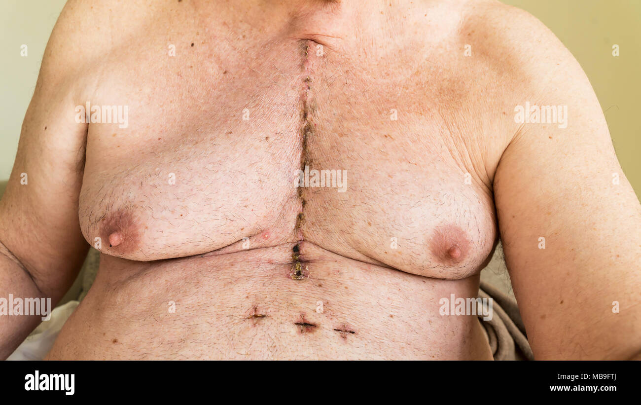 Scar from open heart surgery of coronary artery disease, where the sternum was cut in two, and the rib cage sprung. Below the scar holes show where th Stock Photo