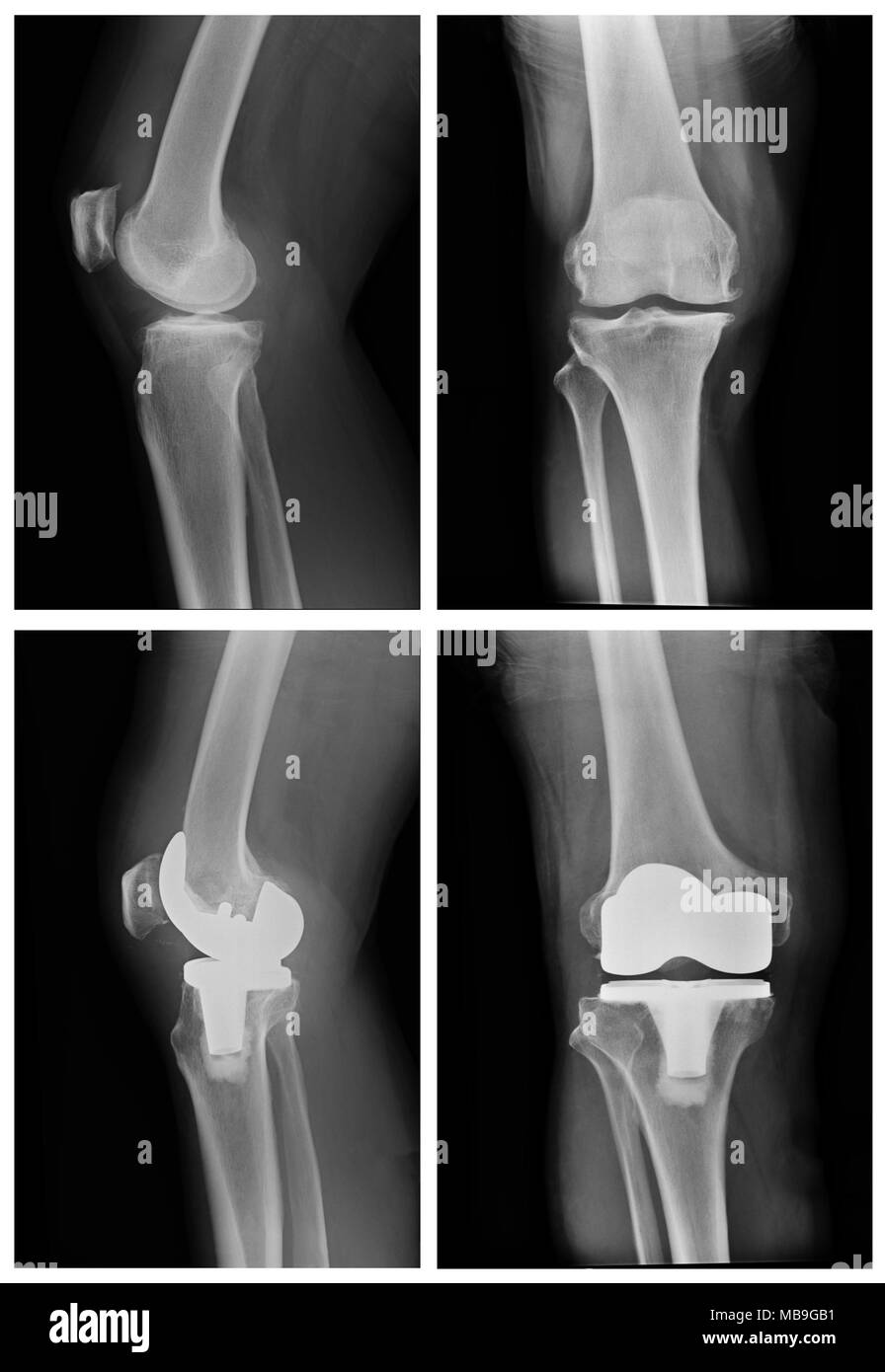 x-ray OA knee and post operation TKA view Stock Photo