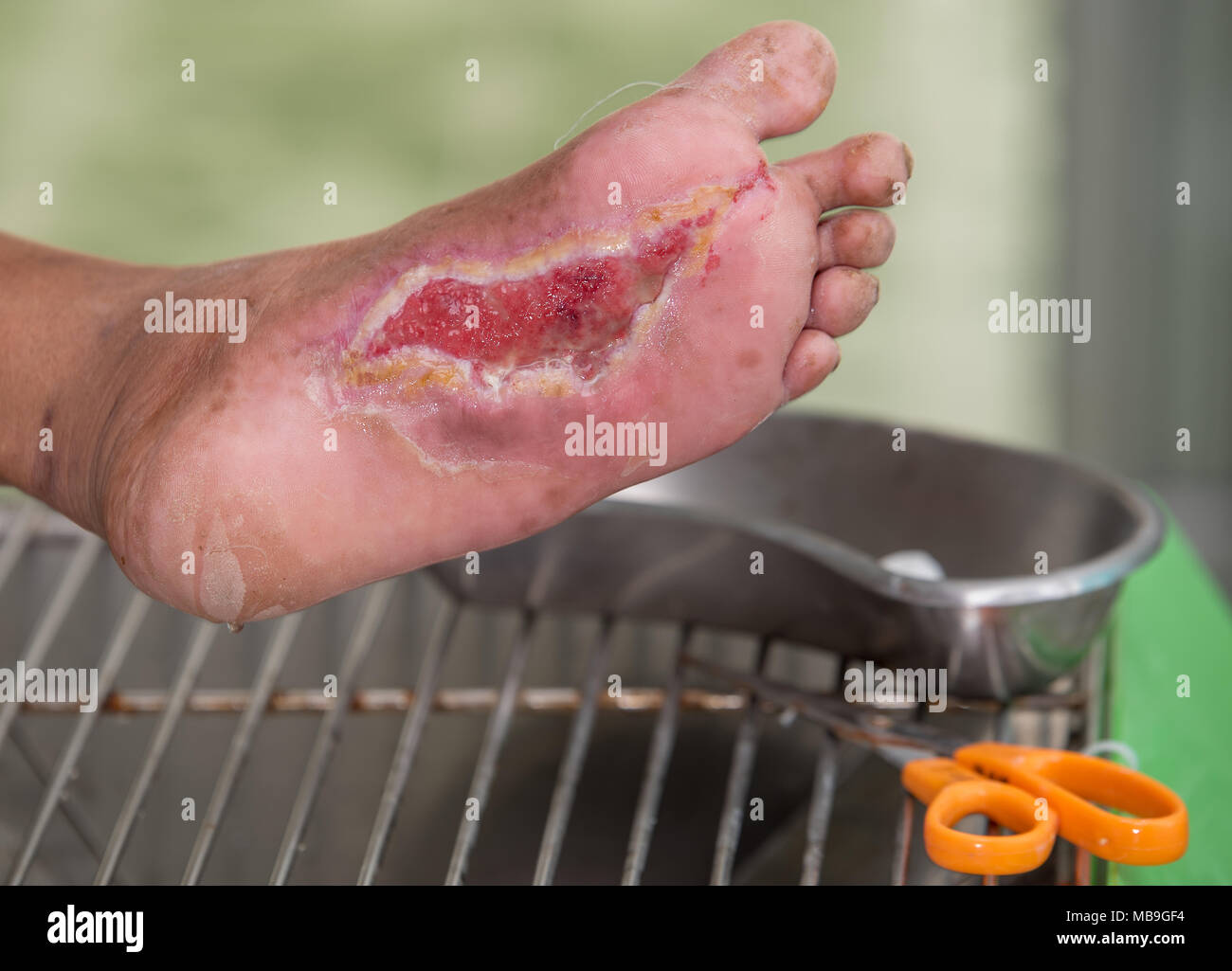 diabetes foot infection, DM patient have wound at arch of foot and chronic infection Stock Photo