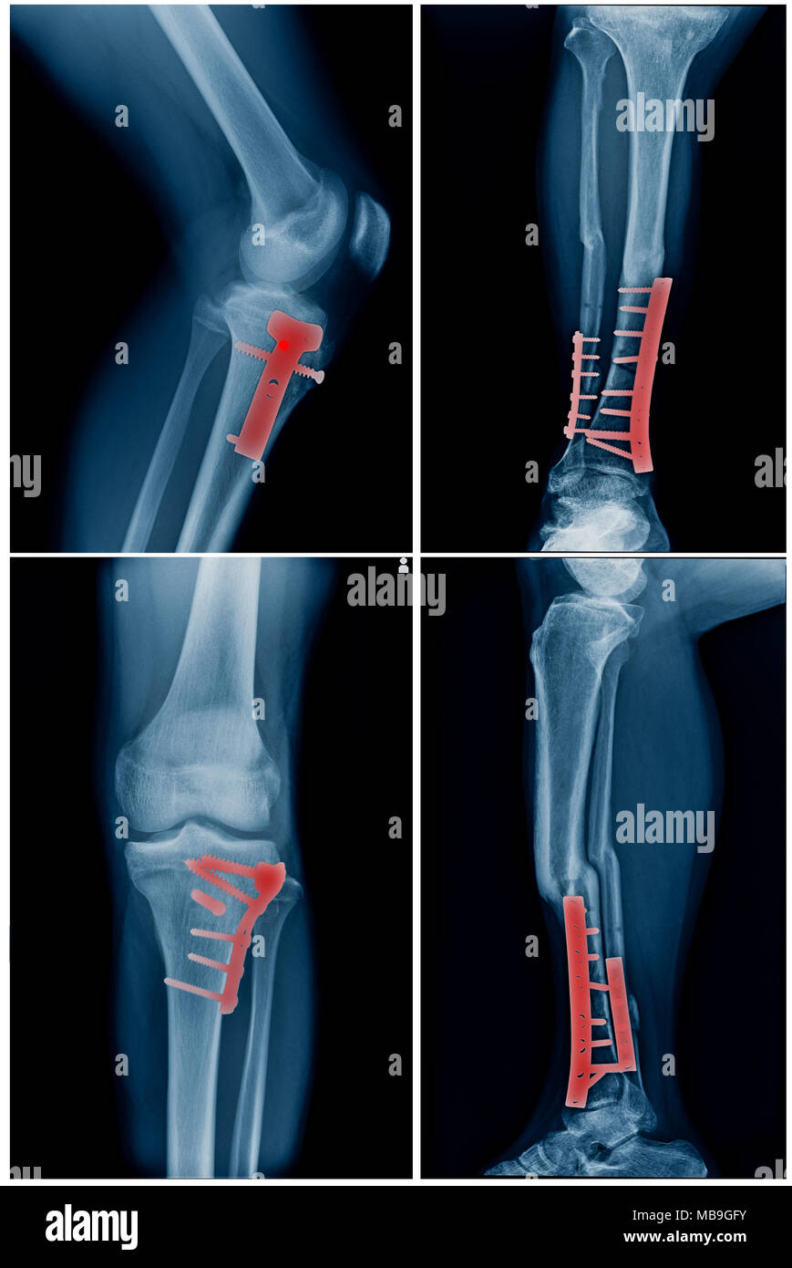collection of leg with post operation internal fixation tibia and fibular bone Stock Photo