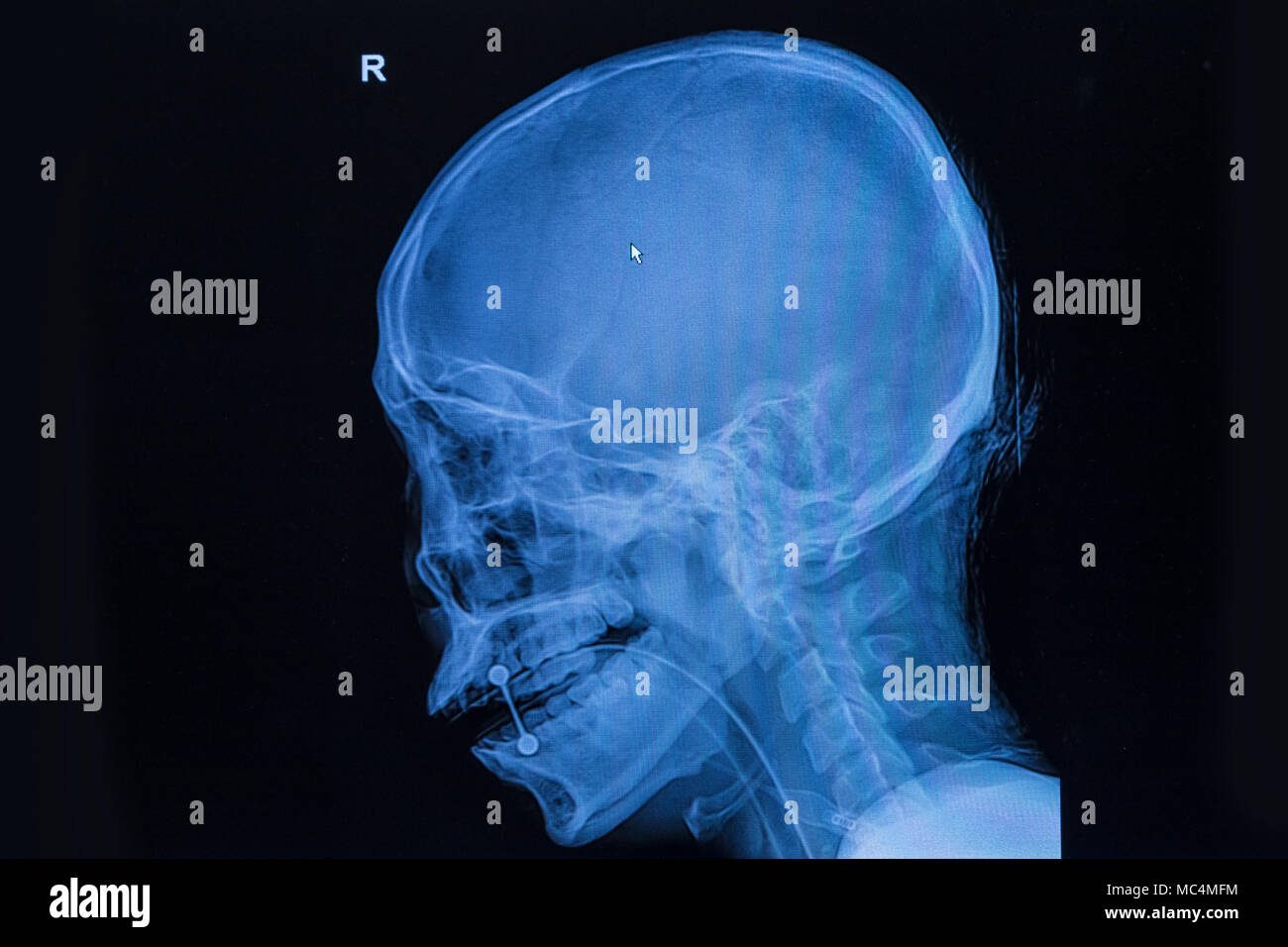 film x-ray skull and cervical spine lateral view Stock Photo