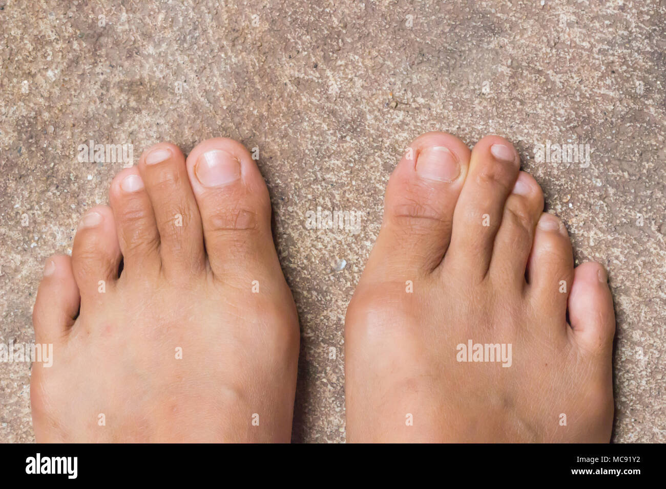Foot, Rheumatoid foot disease background. Stock Photo