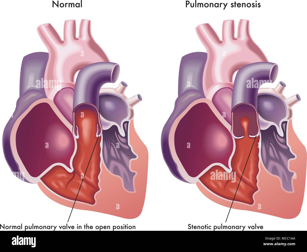 An illustration of a human heart with normal pulmonary valve and a heart with a stenotic pulmonary valve Stock Vector