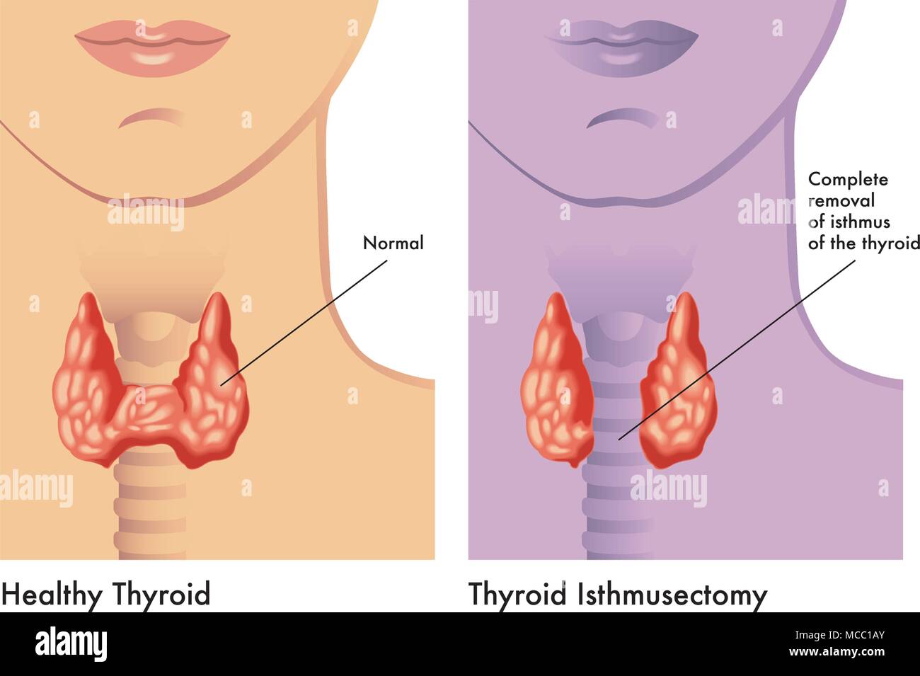 Simple medical illustration of an operation of thyroid Isthmusectomy Stock Vector