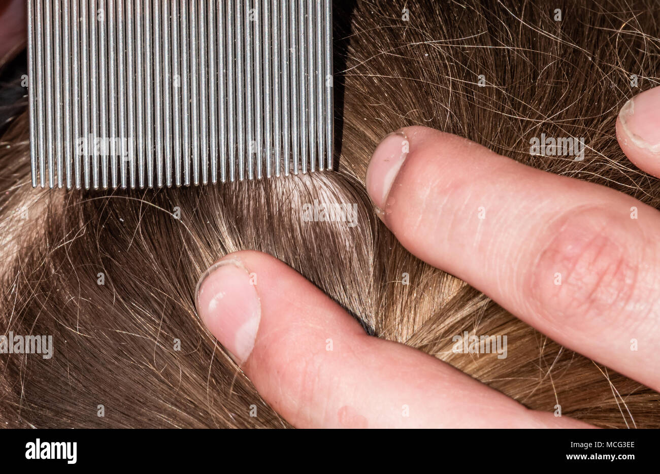 Head lice hires stock photography and images Alamy