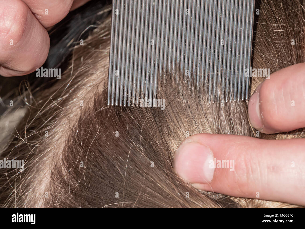 Head Lice Infection Stock Photo 179833568 Alamy