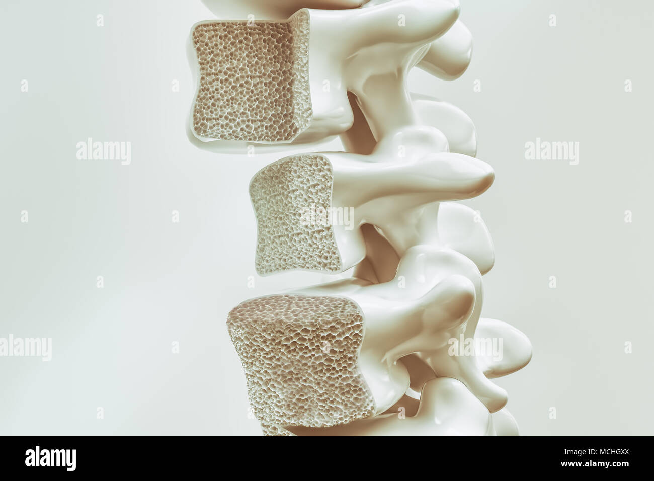 Osteoporosis on the spine - 3d rendering Stock Photo - Alamy