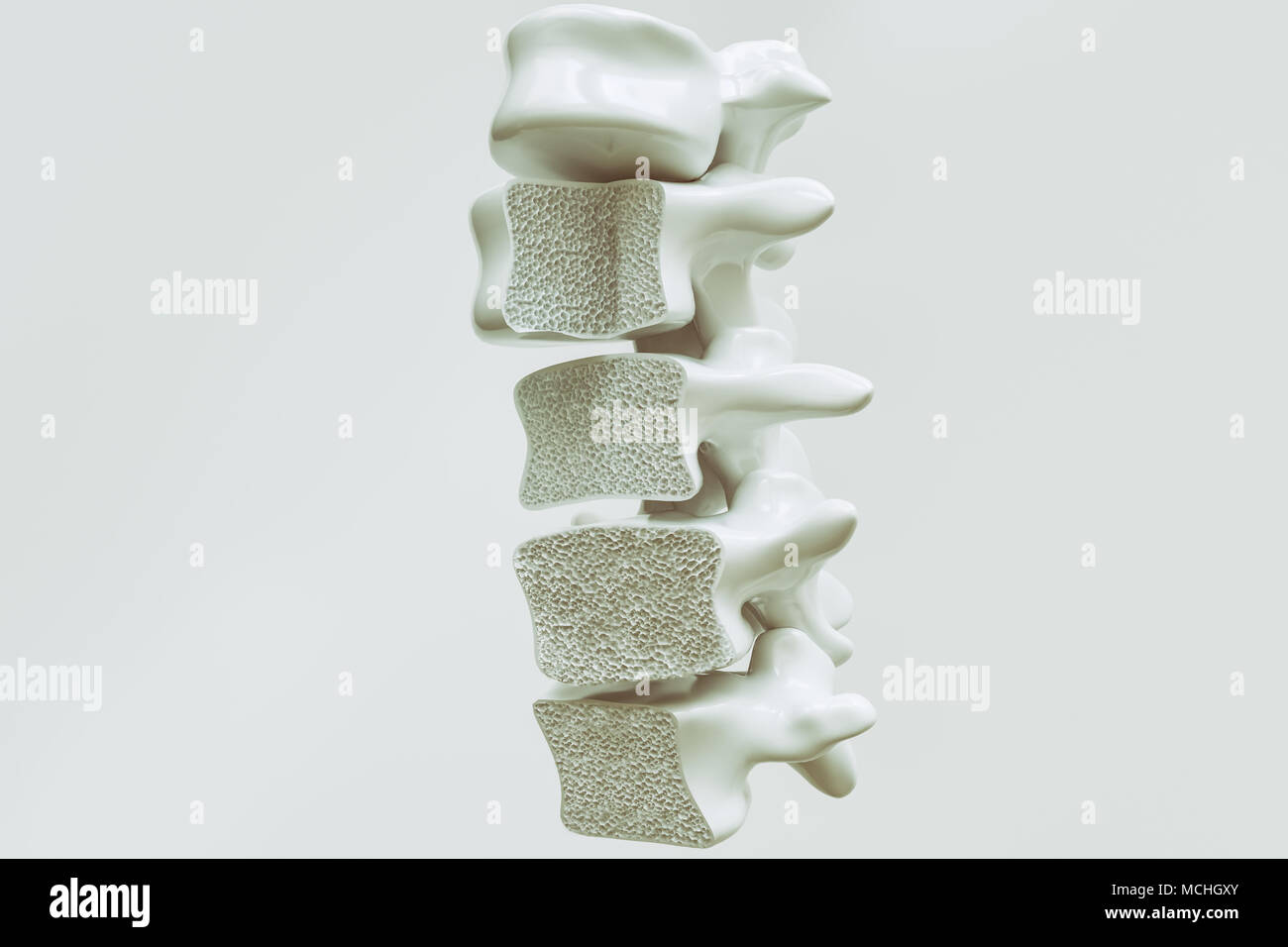 Osteoporosis on the spine - 3d rendering Stock Photo - Alamy