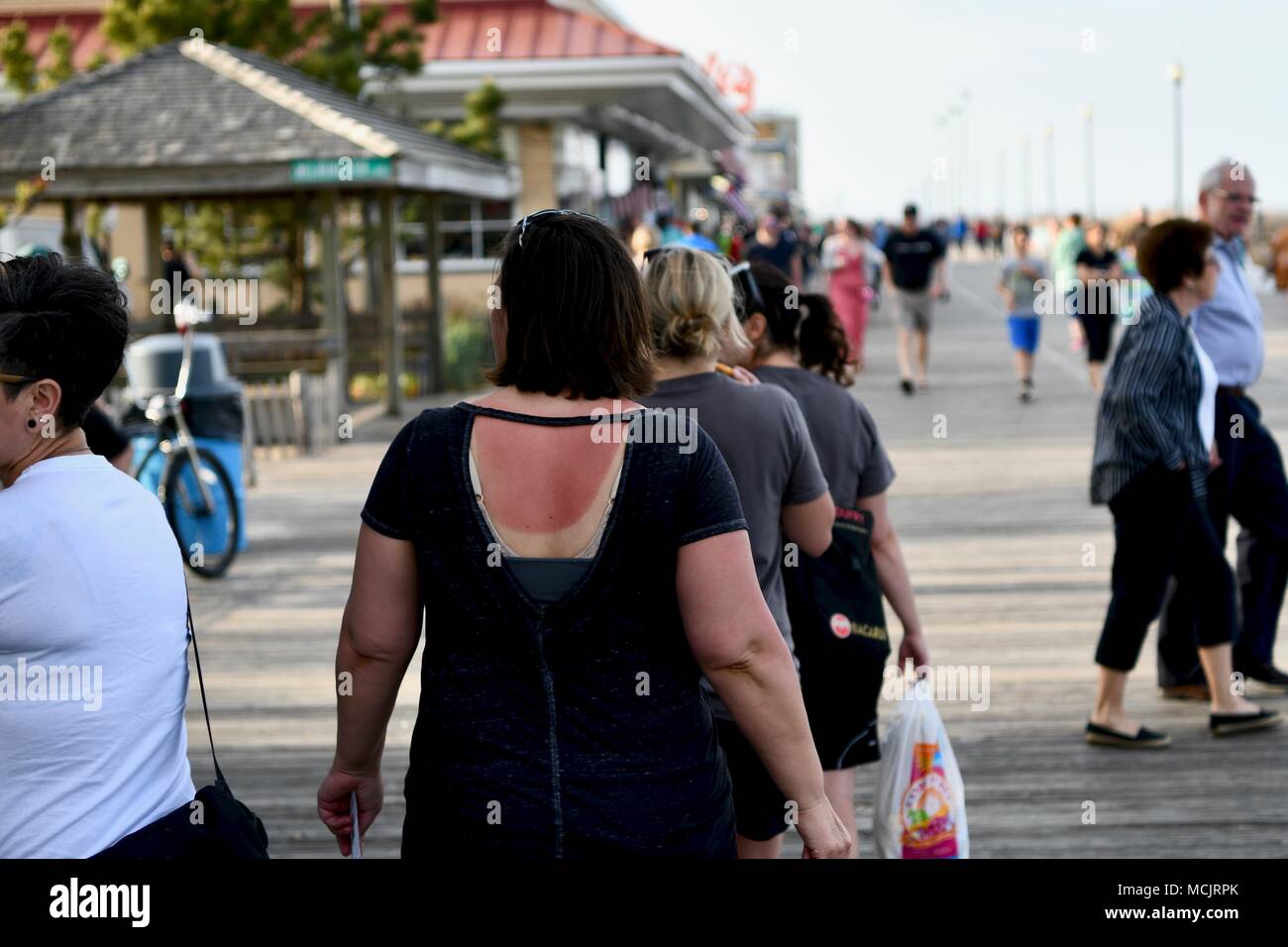 Woman with bad sun burn on back, USA Stock Photo