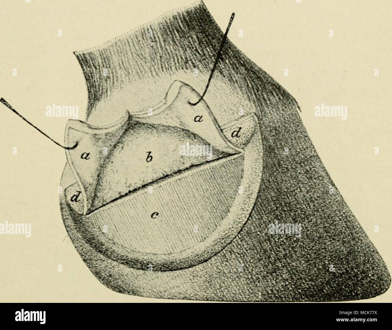 . Fig. 139.—Excision of the Lateral Cartilage (Old Method). The wall covering the lateral cartilage first thinned and stripped off; the two flaps (a, a) of skin and the coronary cushion made by the vertical incision turned back. a, The operation flaps; b, the exposed cartilage; c, the sensitive laminae; d, the coronary cushion. fall into position. They are then sutured with carbolized gut, and the wound finally dressed as to be described later (p. 357). Second Method (after Moller and Frick*).—These operators deem it wise to leave untouched the skin of the coronet and the coronary cushion. The Stock Photo