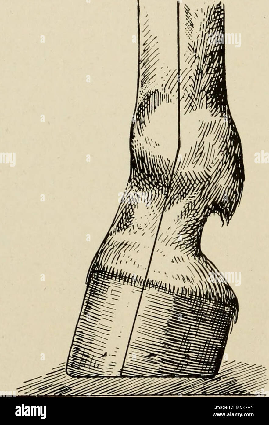 Fig The Club Foot Much Too High When The Condition Is Slight The Wall Of The Toe Is About As High As That Of The Heels While In The Most Marked Form