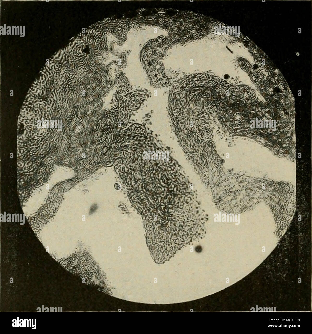 . Fig. 151—Highly Magnified Fold of the Mucosa in Chronic Catarrhal ...