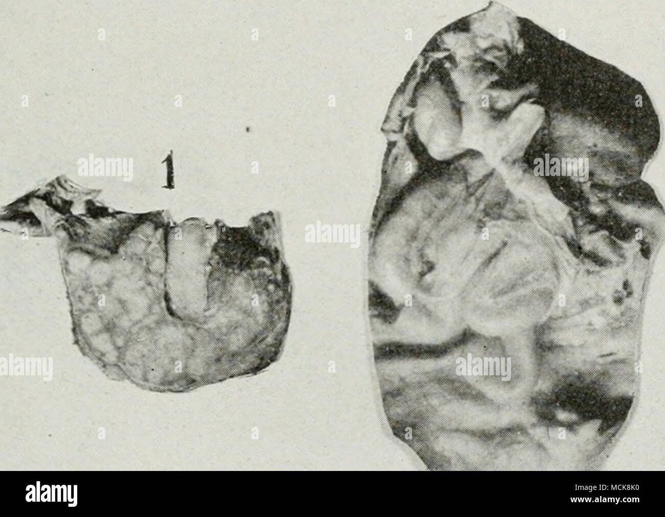 3 1 Tb R V Ci Fig 100 Tuberculosis Of Ovary And Oviduct Section Through Oviduct 2 Oviduct Thrown Into Coils By Elongation J Ovary Sliowing A Corpus Luteum Ci And 3 1 Tb R V Ci Fig 100 Tuberculosis Of Ovary And Oviduct Section Through Oviduct 2 Oviduct Thrown Into Coils By Elongation J Ovary Sliowing A Corpus Luteum Ci And