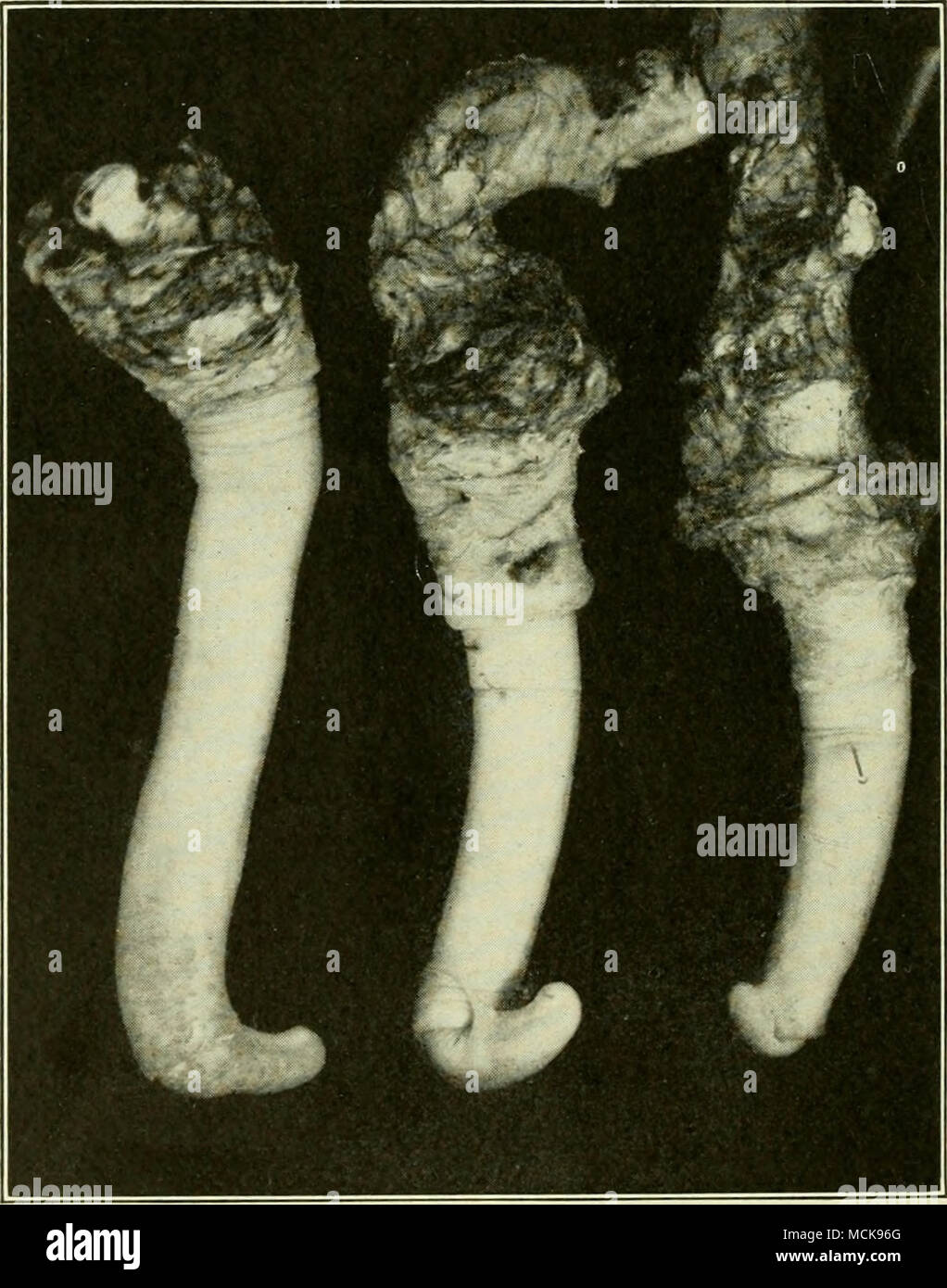 Manuel de médecine opératoire . Phimosis. FiG. 601, Procédé de L. Le Fort.  Section du prépuCfe. gland, des pinces à anneaux, et dun coup de bistouri  on coupetout ce qui dépasse ces