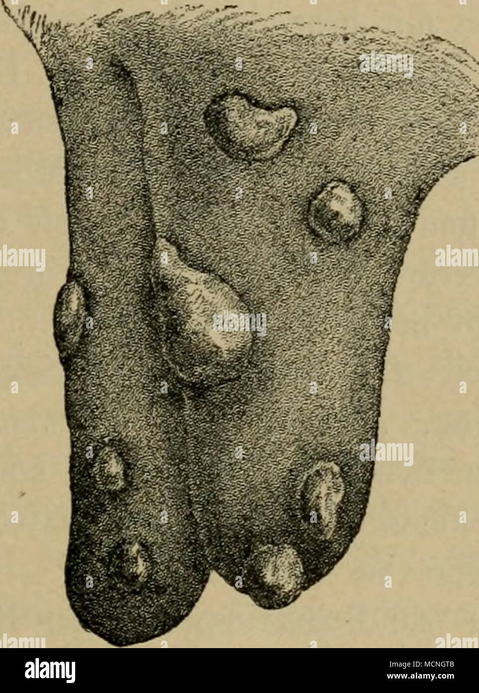 . Maul- und Klauenseuche des Kuheuters nach Schindelka. kamniig gebaut. Sie erreichen bis Taubeneigröße (beim Rinde). Die Blase maclit alle Modifikationen der Blasenexantheme (seröser, trüb-eitriger Inhalt, Berstung der Blasendecke, Substanzverlust, Heilung unter Schorfbildung) durch. Im Munde erreicht die Blasenbildung natürlich nur eine geringe Intensität; die Blasendecke wird sehr bald erodiert; nur die Schleimhaut der Zungenfläche des Rindes kann zu einer mächtigen Blase abgehoben werden. Die Blasen an den Klauen der Schweine sind sehr groß, die Haut der Klauen- krone und der Ballen bilden Stock Photo