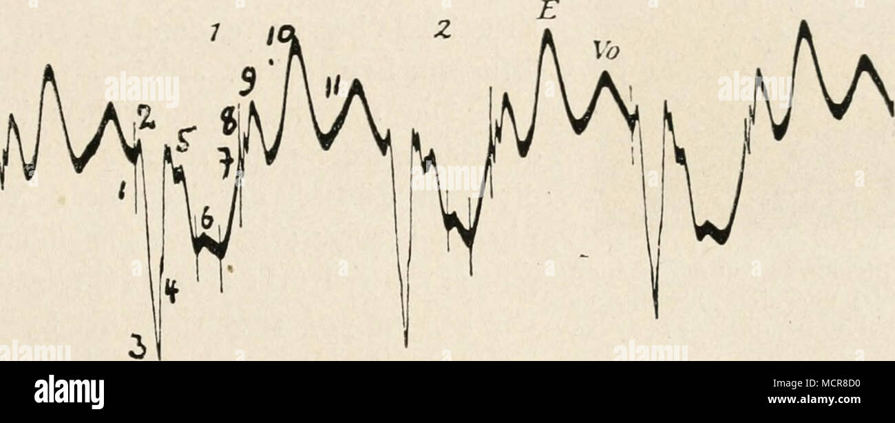 . Fig. 143. Volumenkardiogramm von der Herzspitze des Menschen, mit dem Phonendoskop aufgenommen. Nach O. Hess. Dann sinkt die Kurve wieder (5) wegen der systolischen Volumenverminde- rung herab, d. h. der systolische Teil des Volumenkardiogrammes ist negativ. Die kleine Zacke (6), die unter Umständen sehr hoch sein kann, wird auf eine Inter- ferenz zwischen Form- und Volumenveränderung, d. h. zwischen der Annäherung der Herzspitze an die Brustwand und der durch die Austreibung des Blutes her- vorgerufene Volumenvermindenmg des Herzens zurückgeführt. Die dann folgende Erhebung (7) bezieht 0. H Stock Photo