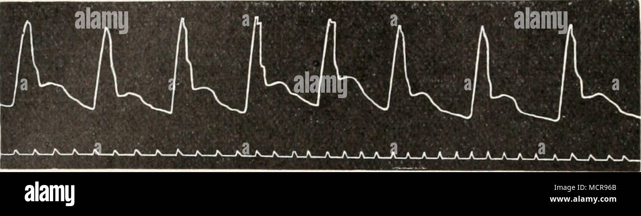 . Flg. 394. Radialispuls mit dem v. Freyschm Sphygmographen geschrieben ...