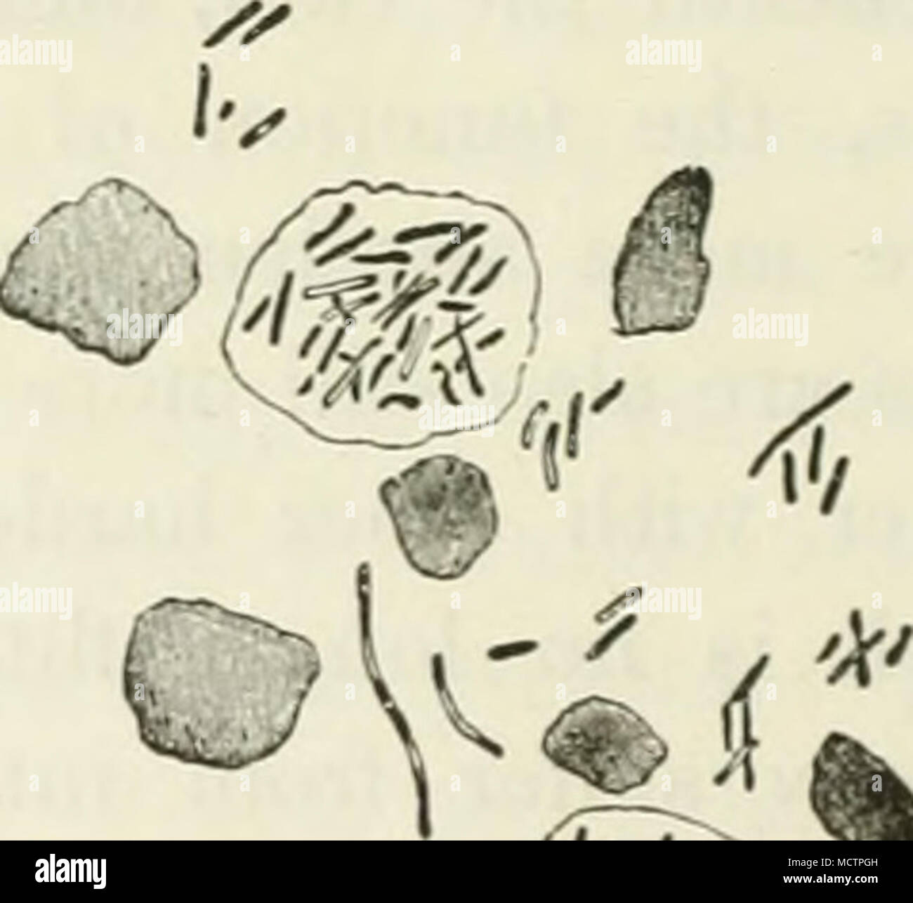 . Fig. 24. From a preparation of caseous matter obtained from pulmonary deposits in Bovine Tuberculosis. Jla^nifying power 700. (After Klein.) The tubercle- bacilli are seen crowded within two hirfje cells, and also scattered between them as a result of the disintegration of other cells. this disease, is a small, round tumour, which is at first semi- transparent, but may afterwards soften or calcify. It is generally spherical, and of about the size of a grain of millet, or hemp-seed. The larger so-called tubercles, spoken of as being as large as a walnut or larger, are in reality aggregations  Stock Photo