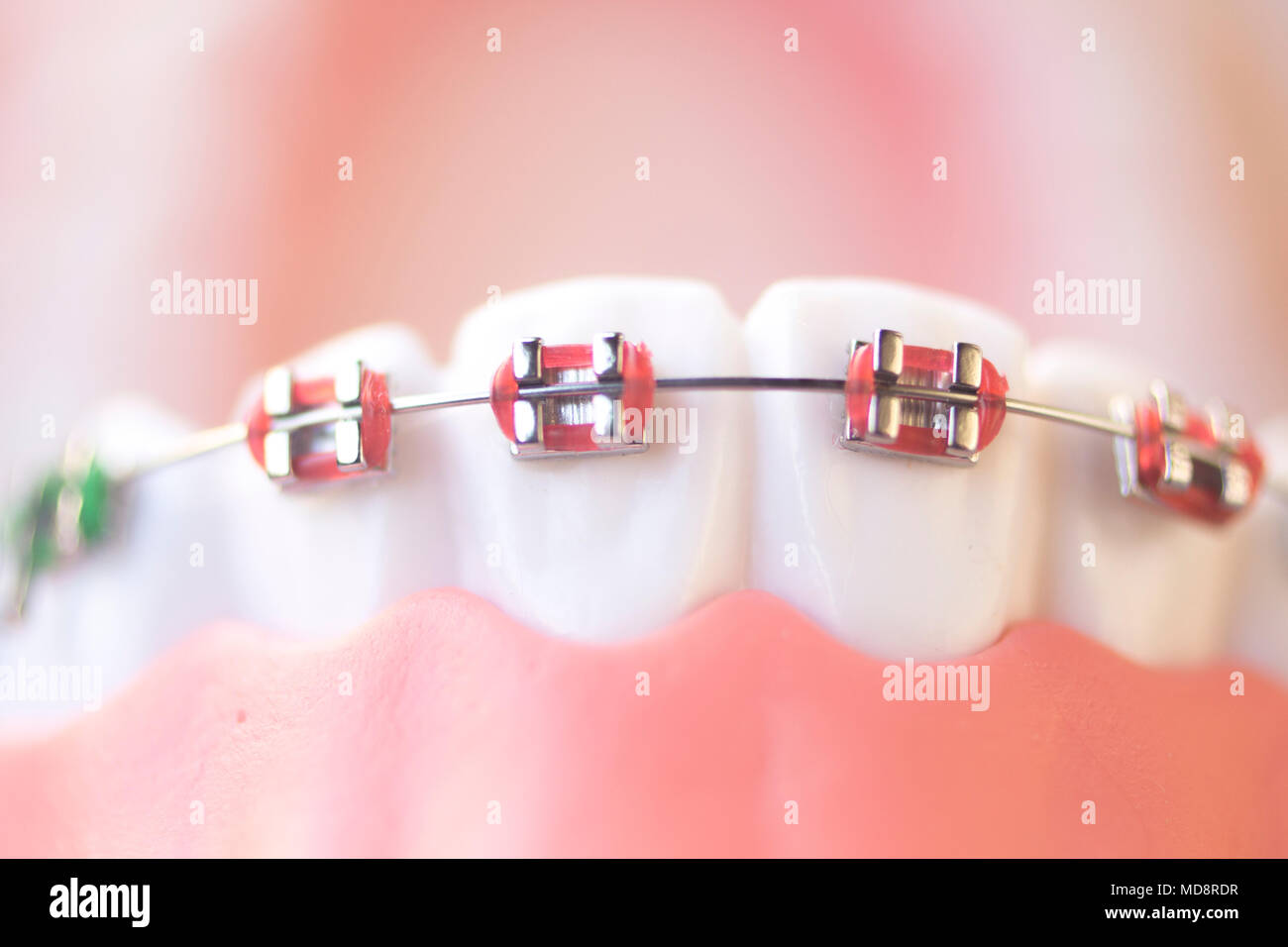 Cosmetic dentistry orthodontics dental metal wire teeth brackets teaching student model Stock