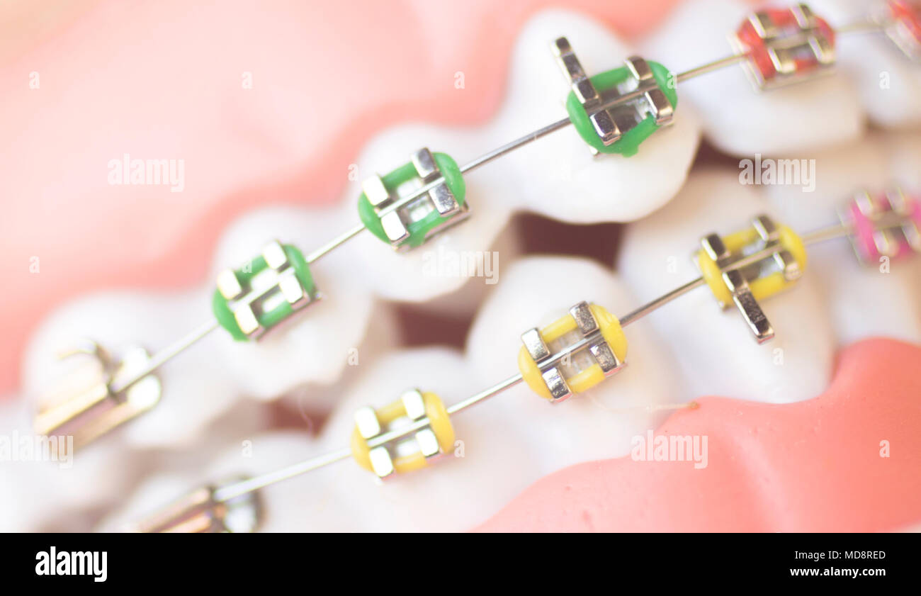 Cosmetic dentistry orthodontics dental metal wire teeth brackets