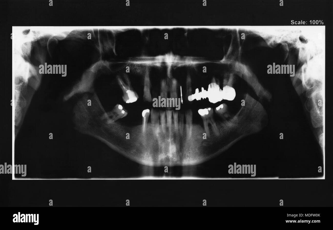 Panoramic radiography of mouth with several implants Stock Photo