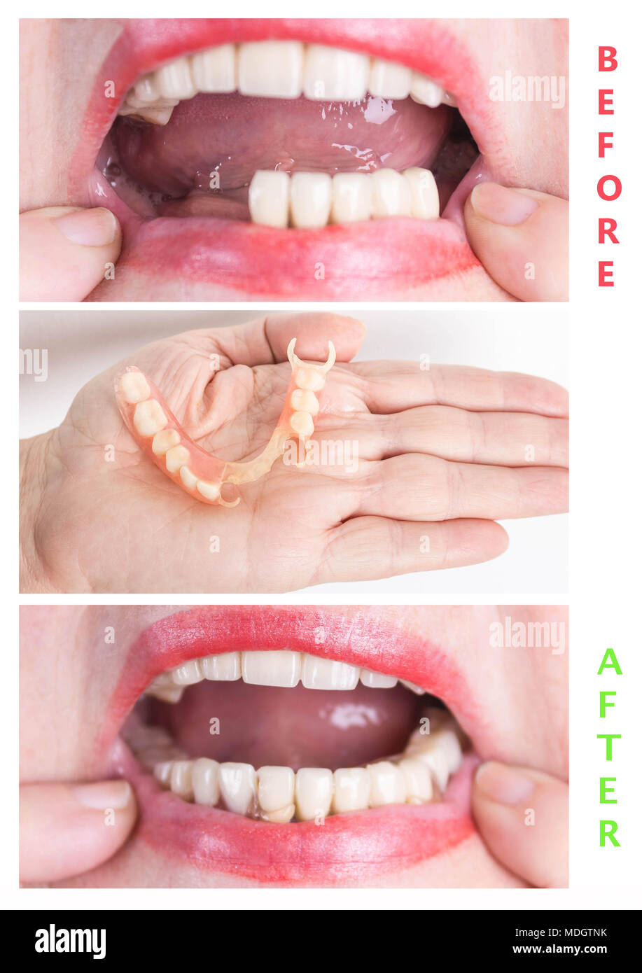 Clasp prosthesis for upper jaw Clasp prosthesis for upper jaw