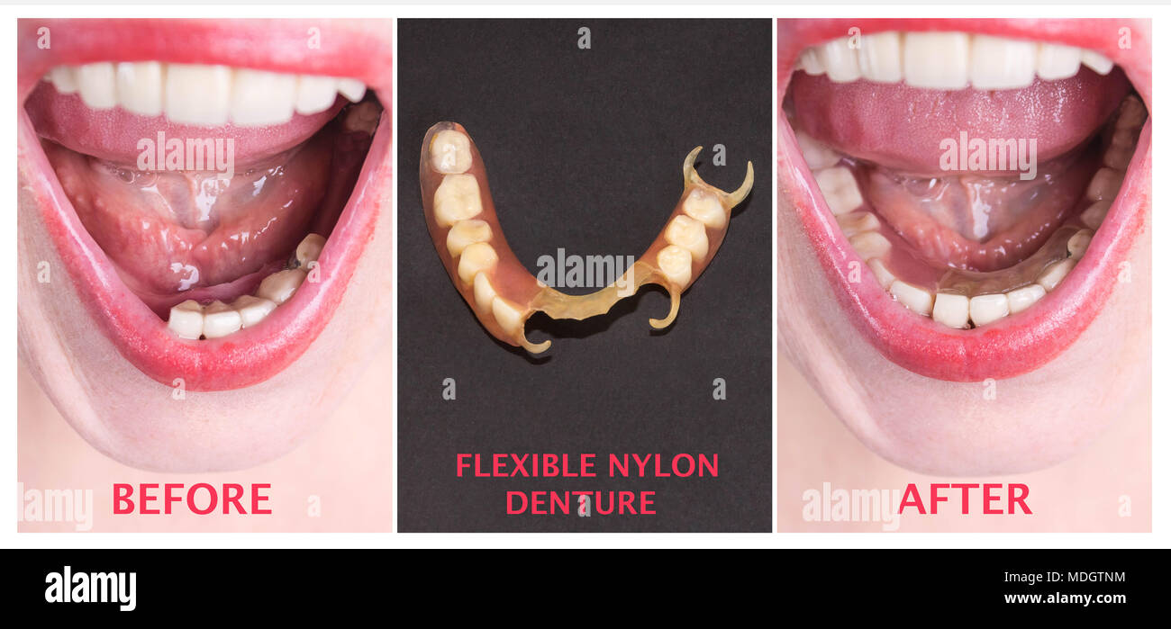 Clasp prosthesis for upper jaw Clasp prosthesis for upper jaw