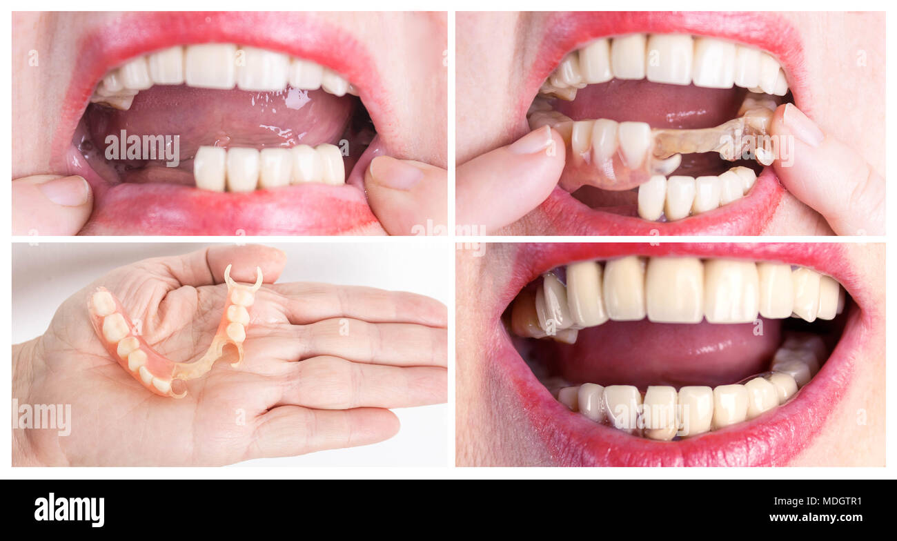 Clasp prosthesis for upper jaw Clasp prosthesis for upper jaw