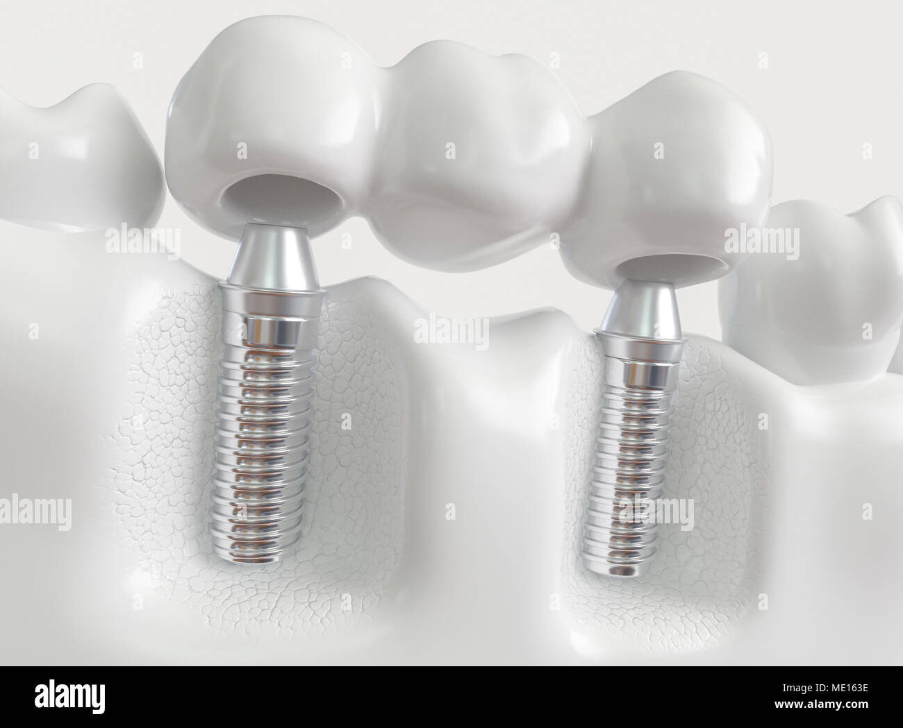Implants with dental bridge - 3d rendering Stock Photo