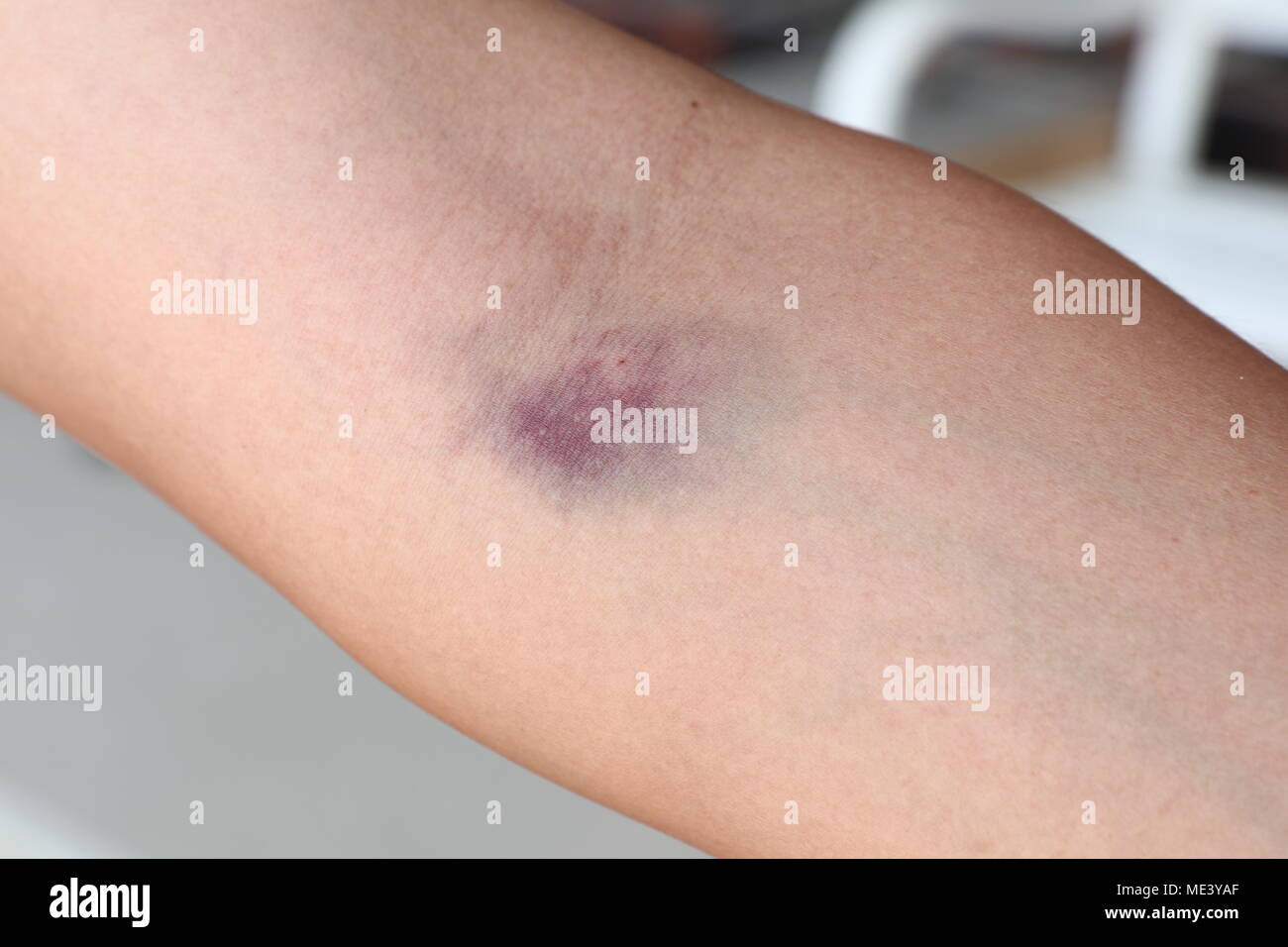 Bruised arm hires stock photography and images Alamy