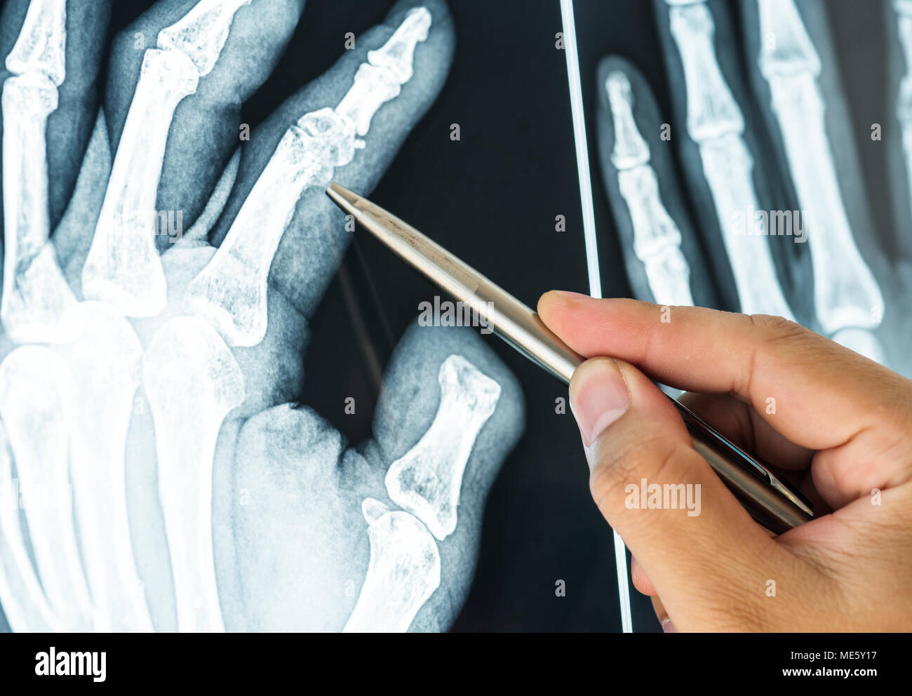 Closeup of x-ray filmof a fractured finger Stock Photo