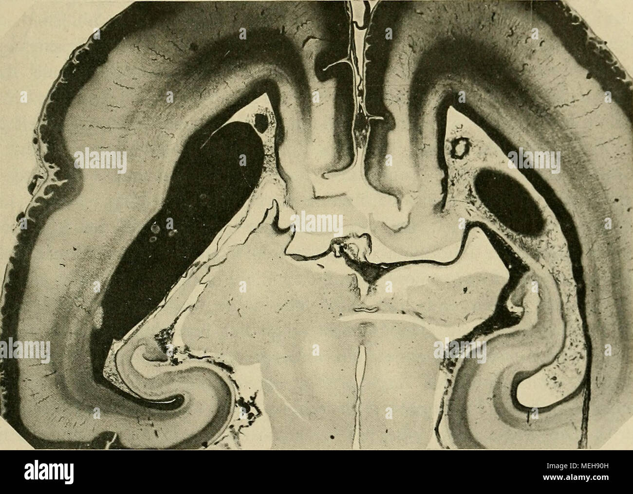 . Die Entwickelung des menschlichen Gehirns : während der ersten Monate : Untersuchungsergebnisse . Fig. 99. Sclinitt unmittelbar hinter dem vorigen. Die beiderseitigen Balkenanlagen sind in der Mitte Ton- einander getrennt. Der Streifenliügel ist links in größerer Ausdehnung getroffen, rechts nur an seinem hintersten Ende. Bei dieser imd bei der vorigen Figur ist die dünne zum Balken herabtretende Schiebt von Rindeusubstanz eine Strecke weit eingerissen. sich öffnender Schlitz schneidet auch hier zwischen beiden Seitenhälften ein. Der Balken zerfällt dadurch in zwei frei hervortretende Hälfte Stock Photo