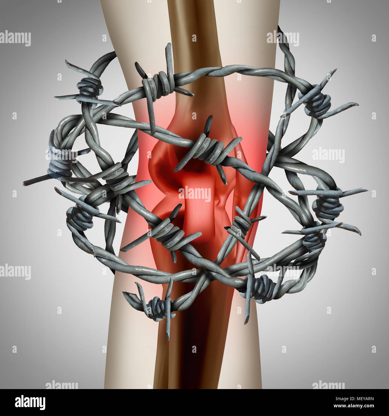 Knee pain and painful joint as a medical illustration of a human skeleton showing a sports injury or a physical accident with barbed wire. Stock Photo