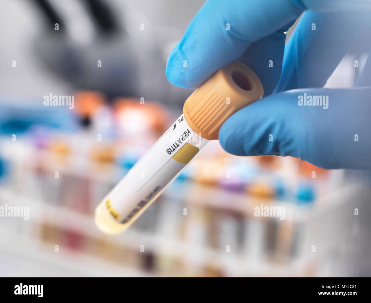 Medical technician preparing a human sample for hepatitis testing Stock Photo
