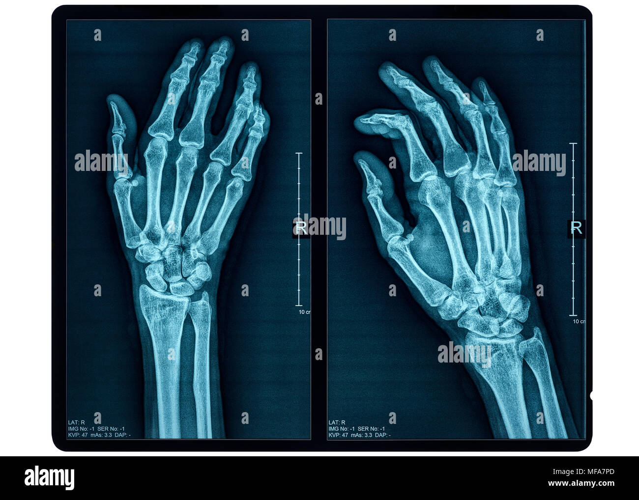 Hand X-ray of an Adult Female Stock Photo