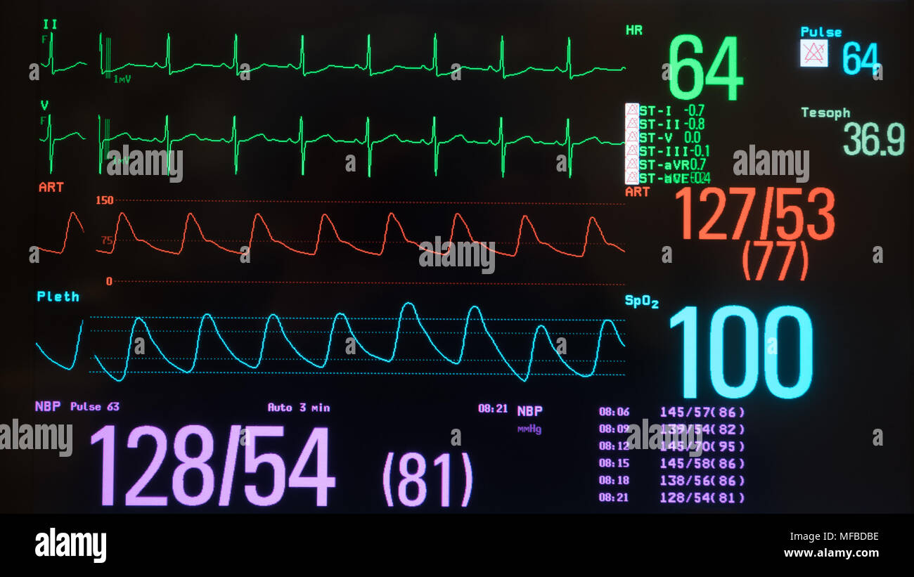 A monitor with a black background showing an ECG with normal sinus rhythm  in green, the arterial blood pressure in red, the oxygen saturation in blue  Stock Photo - Alamy