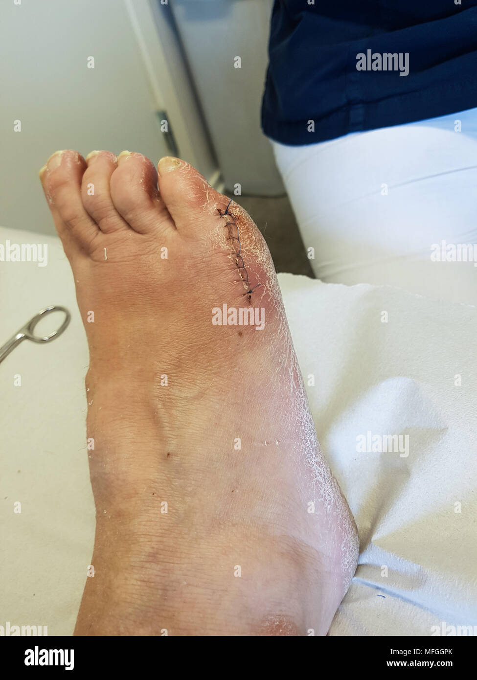 Stiches on the right foot three weeks after a bunion surgery. Stock Photo
