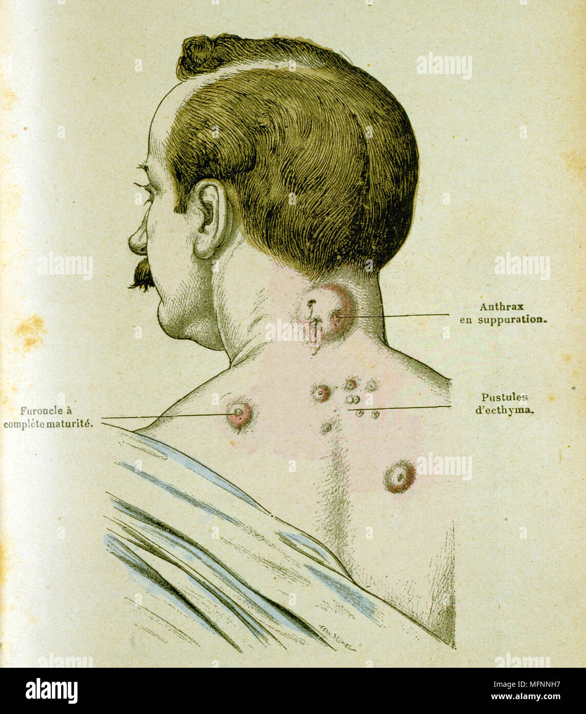 Development of pustules in a man suffering from Anthrax, a disease which could be c ontracted from contact with infected farm animals. The anthrax bacillus was the first bacterium to be identified (1841) and in 1881 Louis Pasteur successfully tested a vaccine on sheep. Engraving c1895. Stock Photo