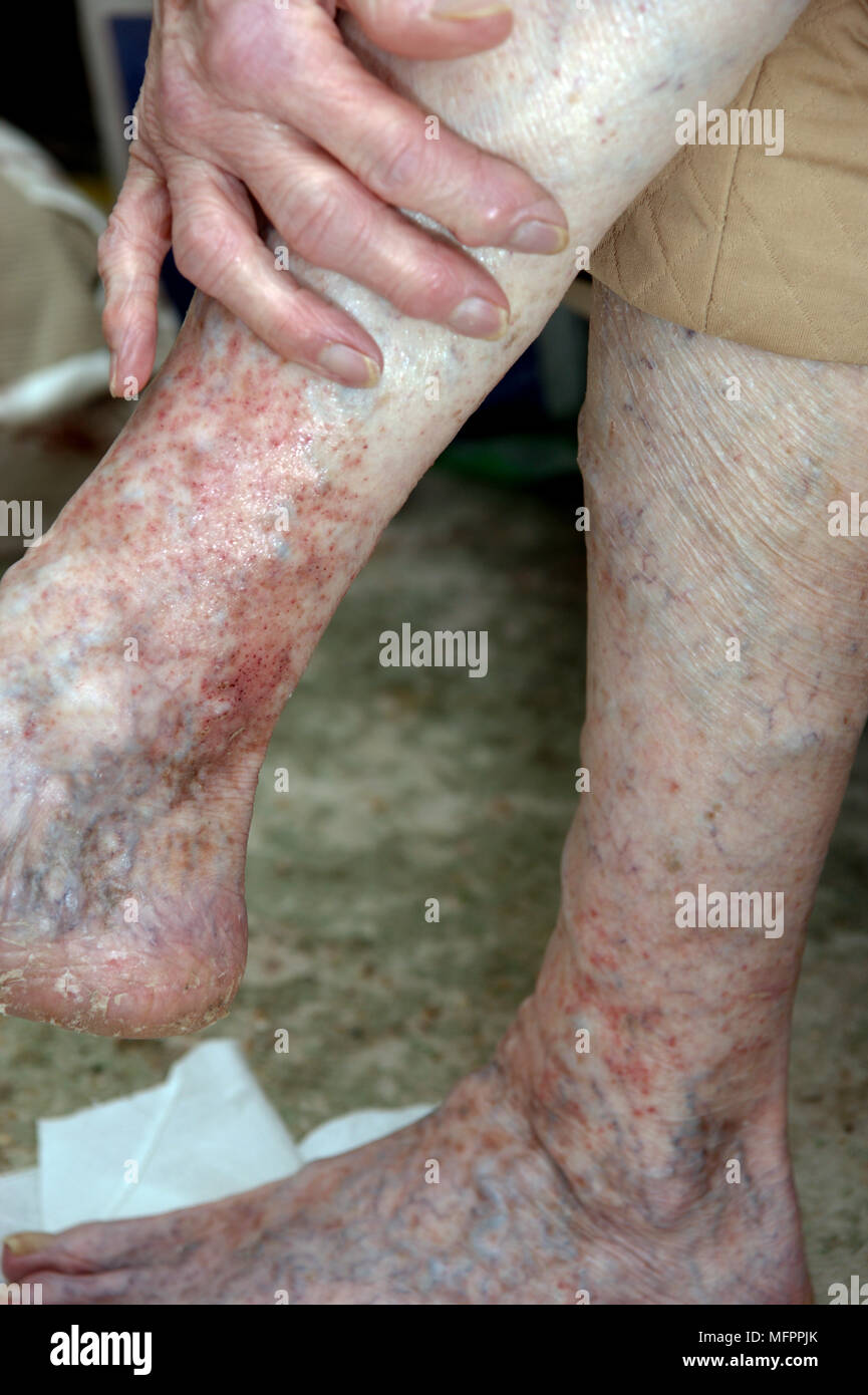 Elderly woman's legs suffering from eczema & varicose veins cream being applied model release Stock Photo